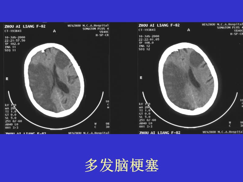 常见疾病的CT片.ppt_第2页