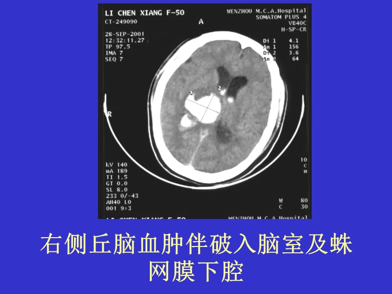 常见疾病的CT片.ppt_第3页