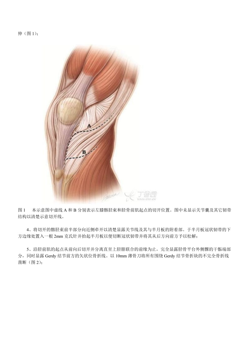 CORR手术技巧：胫骨平台骨折扩大Tscherne-Johnson入路.doc_第2页