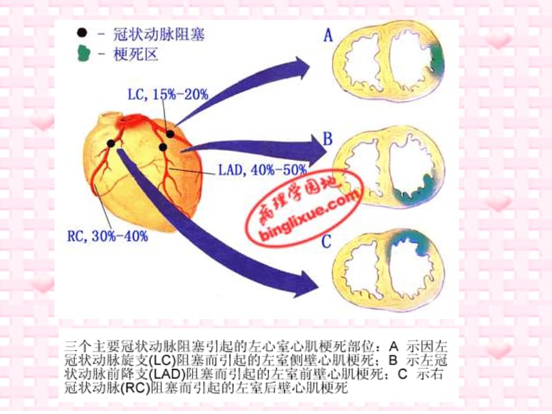 室壁瘤术后护理_李旭.ppt_第3页