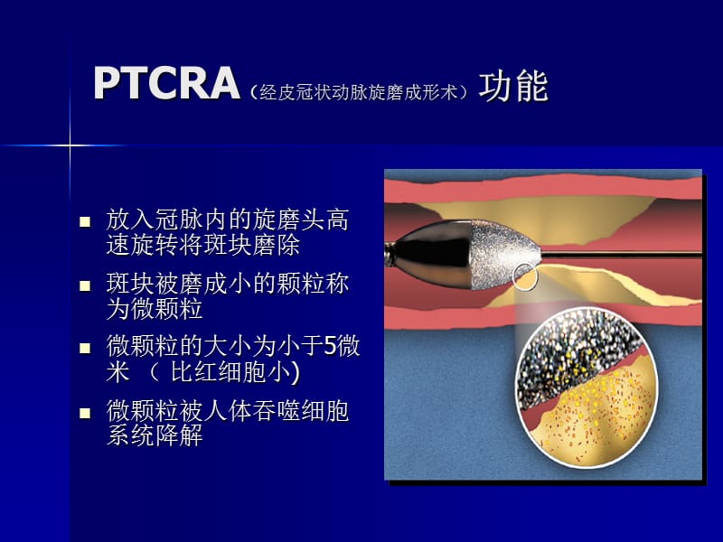 旋磨技术的原理和监护常规.ppt_第2页