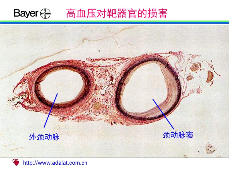 高血压对靶器官的损害（图谱）.ppt_第1页