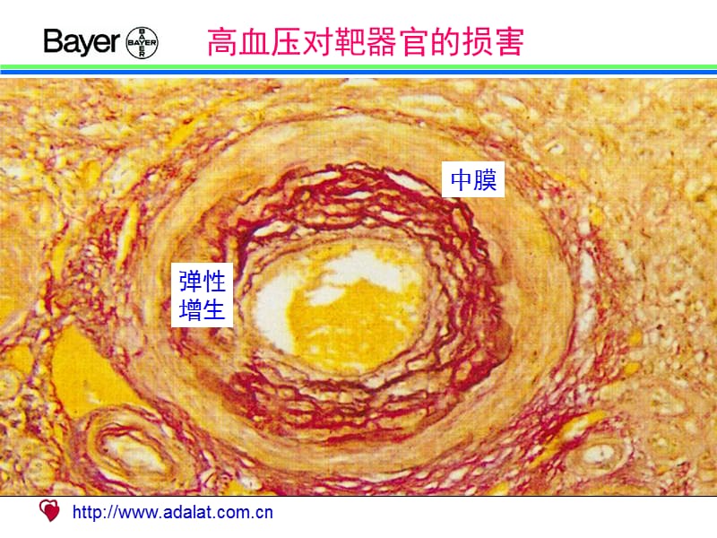 高血压对靶器官的损害（图谱）.ppt_第3页