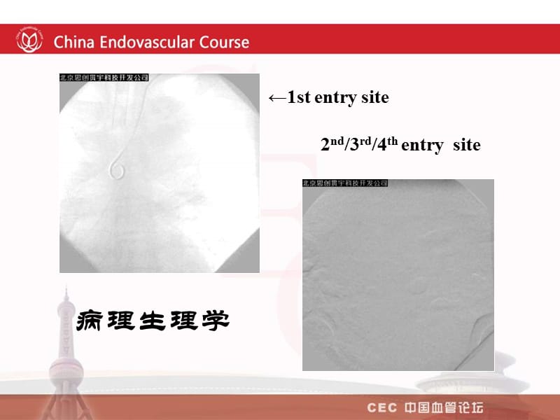 主动脉夹层腔内修复技术----适应症与基本技术_郭伟.ppt_第3页