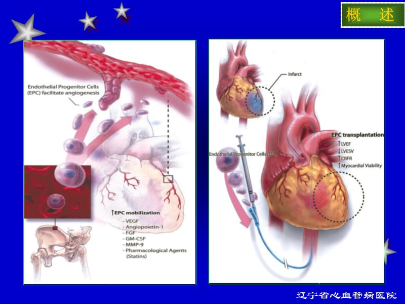 自体外周血干细胞移植治疗急性心肌梗死的临床研究.ppt_第3页