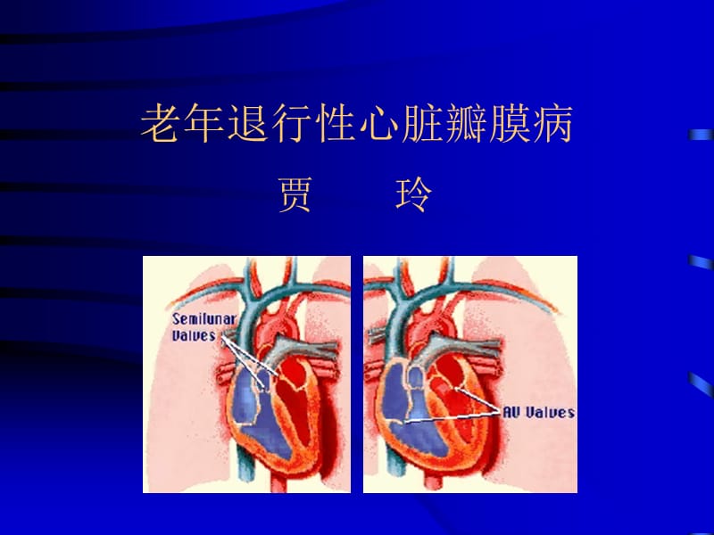 老年退行性心脏瓣膜病.ppt_第1页