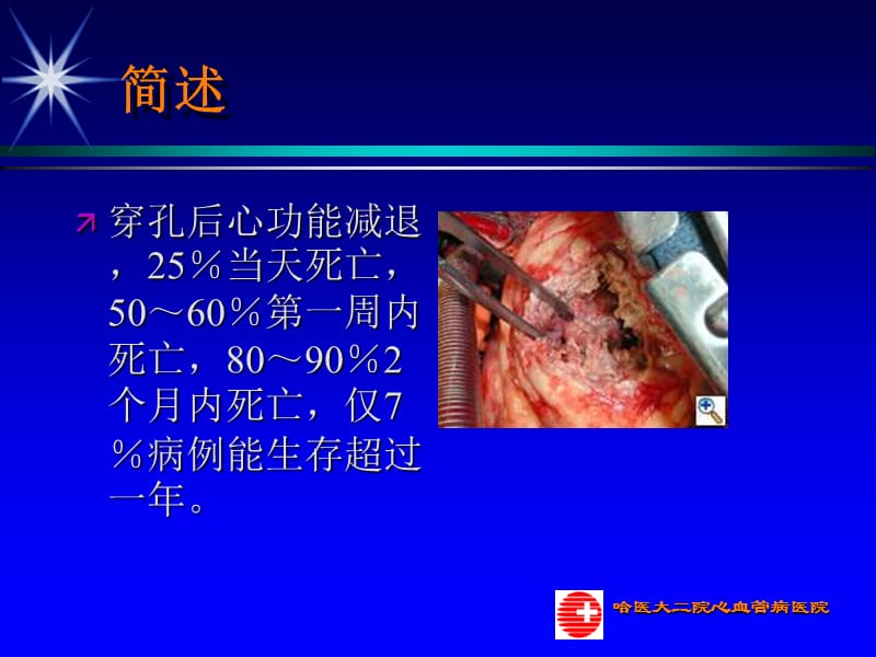 室间隔穿孔的介入治疗及时机选择_于波.ppt_第3页