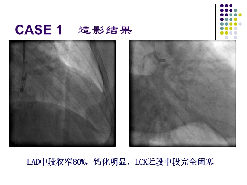 旋磨病历_姜铁民.ppt_第2页