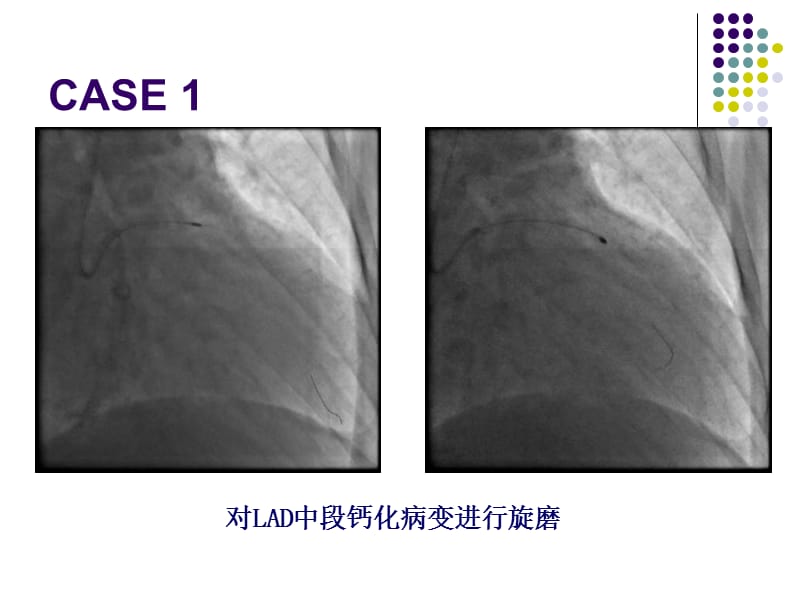 旋磨病历_姜铁民.ppt_第3页