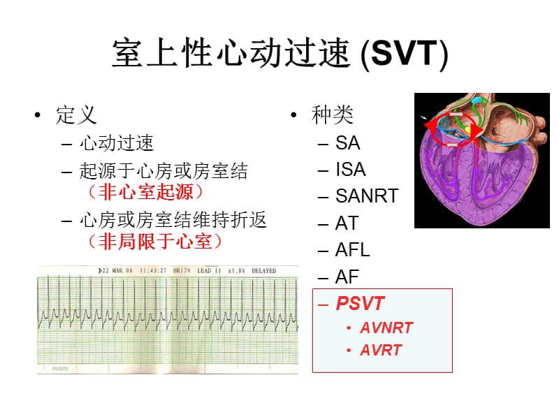 特殊类型室上速的消融进展.ppt_第2页