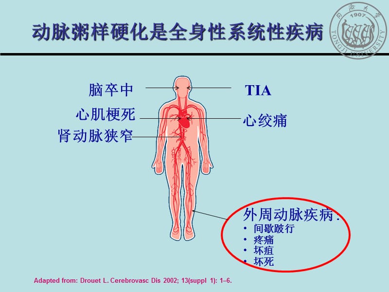 从循证医学证据看关注外周血管疾病的重要性.ppt_第3页