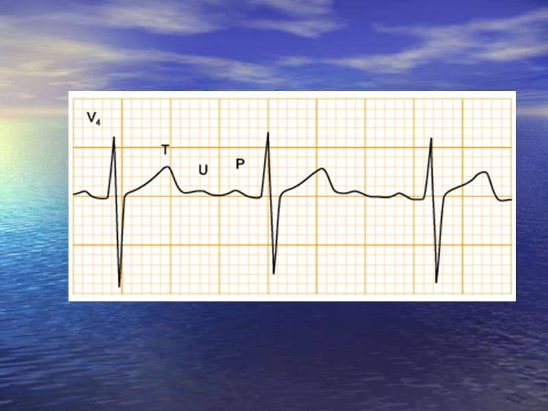 中国区国际心电图培训课程之典型病例.ppt_第2页
