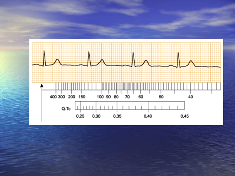 中国区国际心电图培训课程之典型病例.ppt_第3页