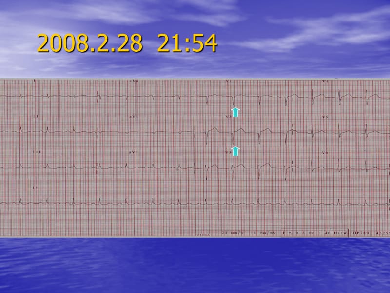 应激性心肌病Stress-Induced Cardiomyopathy.ppt_第3页