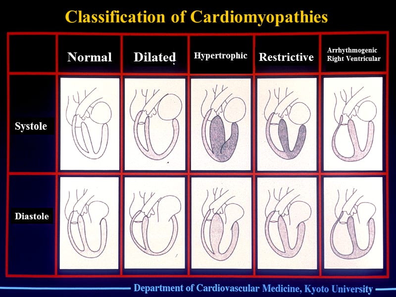 心肌病的分类（英文）-课件，幻灯，PPT.ppt_第2页