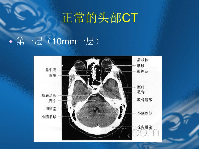 CT片的阅读技巧(头部)PPT课件.ppt_第3页