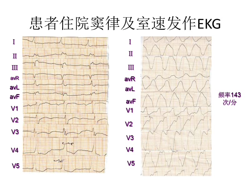 长PR间期引起ICD误放电.ppt_第3页