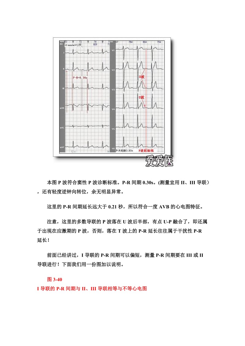 2019第六讲P-R间期与P-R段分析.doc_第2页