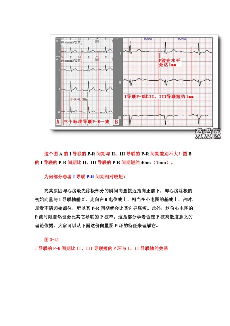 2019第六讲P-R间期与P-R段分析.doc_第3页