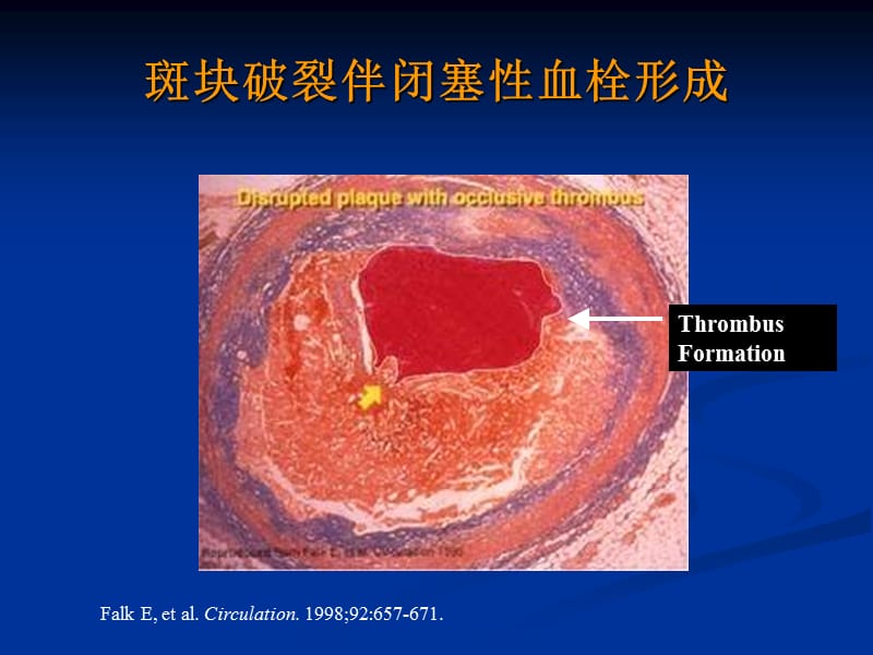 ami再灌注治疗策略的具体考虑-课件，幻灯.ppt_第2页