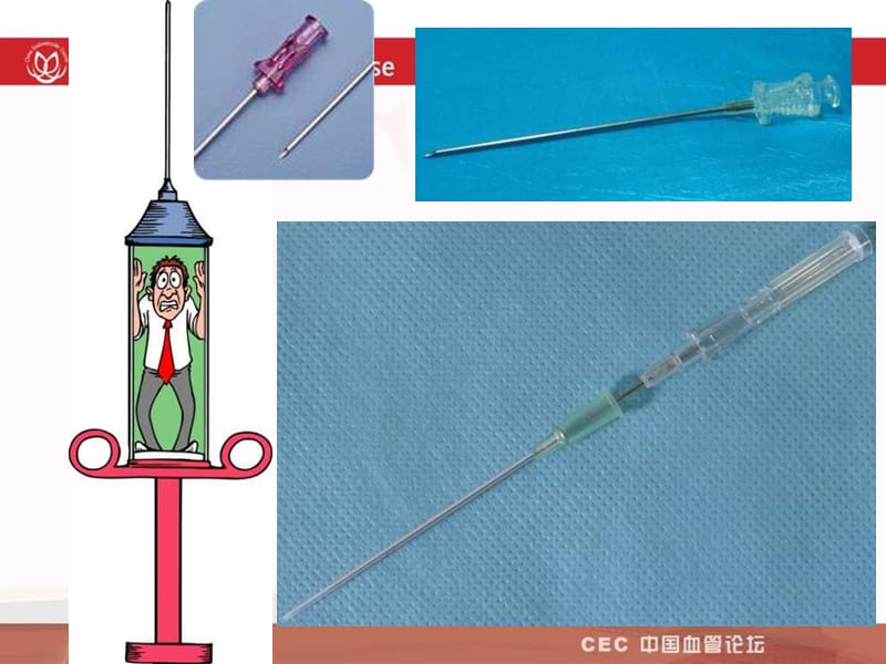 sfa病变腔内治疗的入路与器材选择_李鸣.ppt_第2页