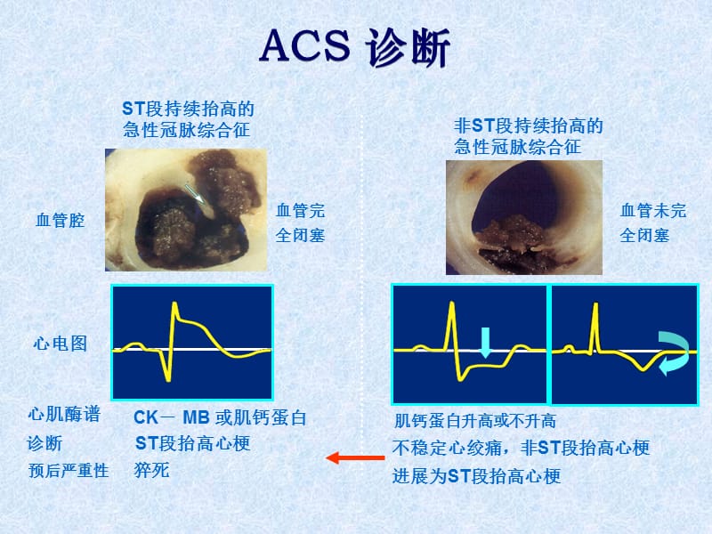 nsteacs疾病的诊断与治疗.ppt_第3页