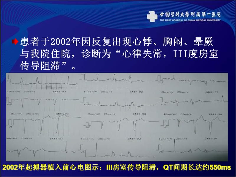 iii度房室传导阻滞及获得性长qt心衰患者起搏器升级治疗选择与疑惑_程颖.ppt_第3页