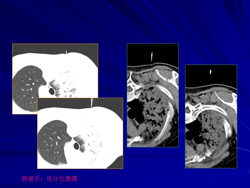 医学ppt--蒋钢肺穿刺4月修改.ppt_第3页
