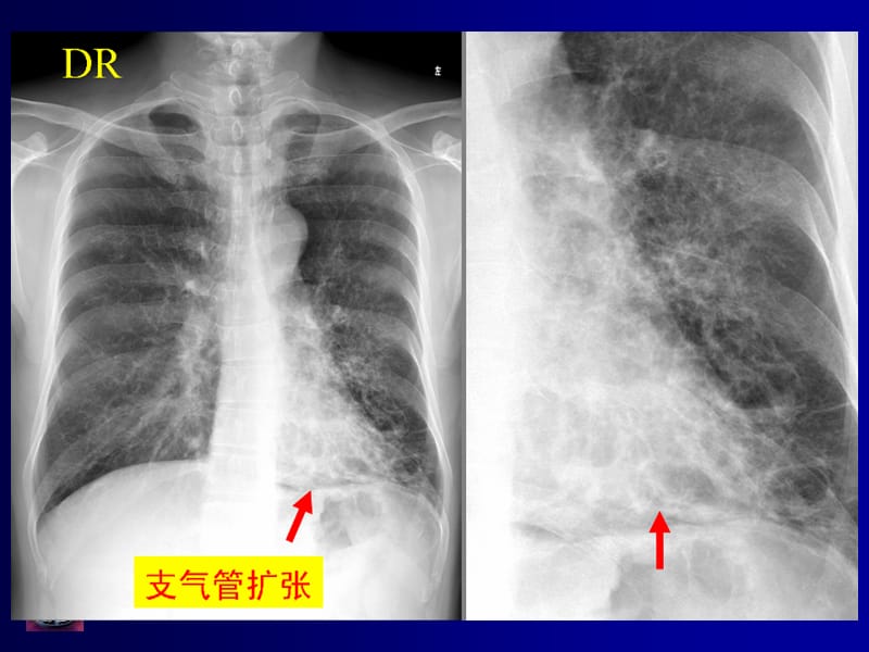 呼吸系统影像诊断.ppt_第3页