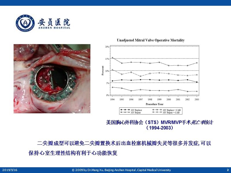 二尖瓣瓣环成形技术.ppt_第2页