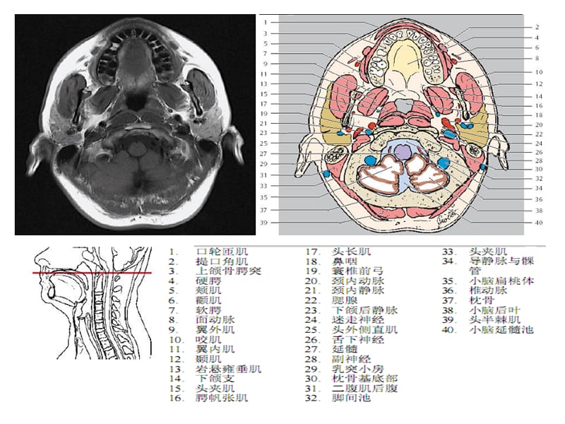 头颈CT-MRI解剖图解第五季.ppt_第3页