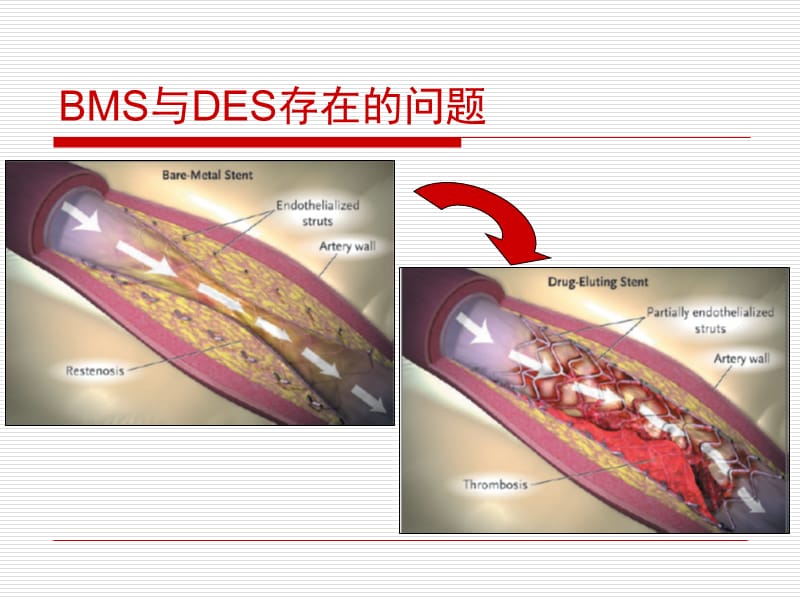 支架内血栓形成的机制与防治.ppt_第3页