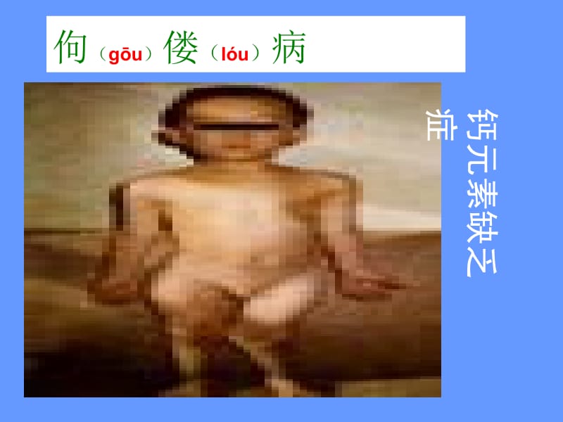 佝gōu偻lu病精品PPT.ppt_第2页