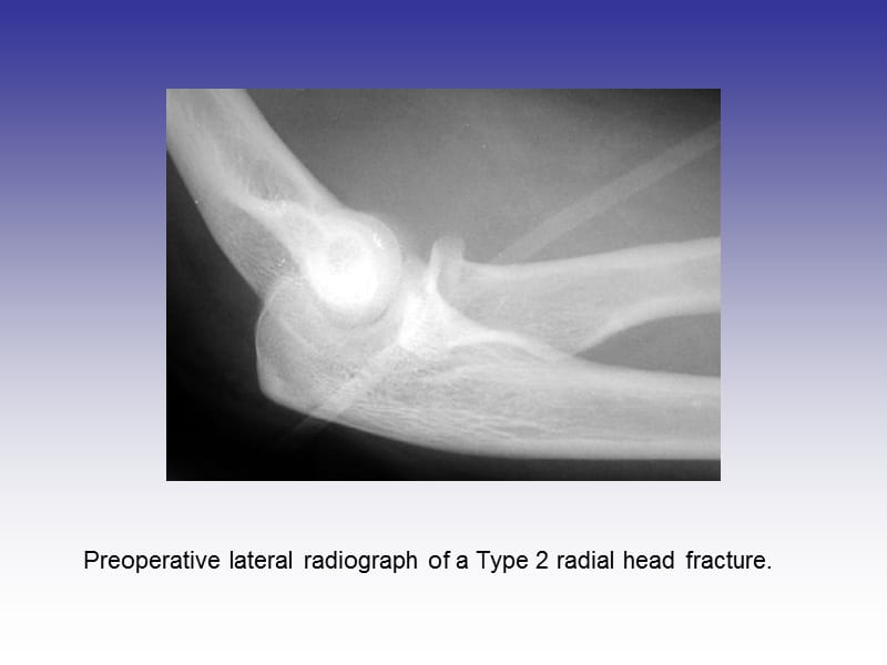 桡骨小头骨折切开内固定.ppt_第2页