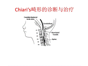 2019年chiari畸形的诊断与治疗.ppt