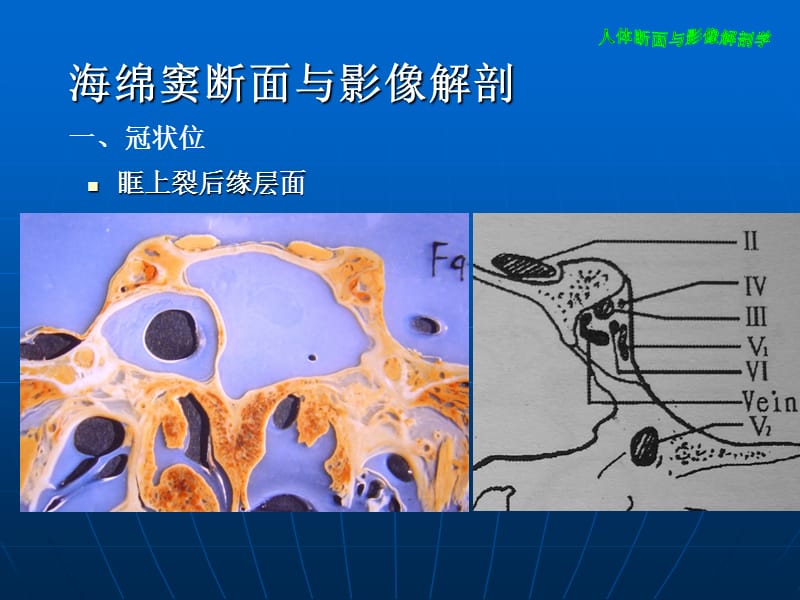 海绵窦断面与影像解剖PPT课件.ppt_第1页