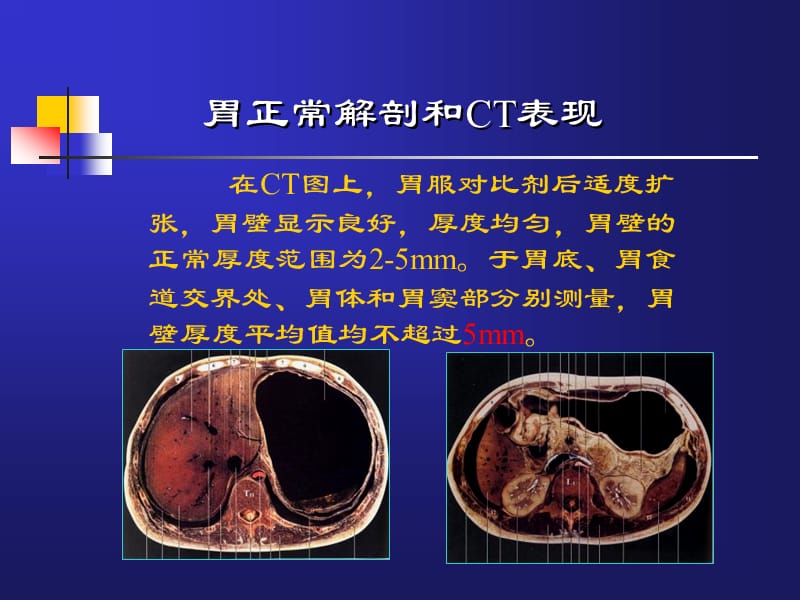 胃肿瘤CT诊断_新疆石河子大学.ppt_第2页