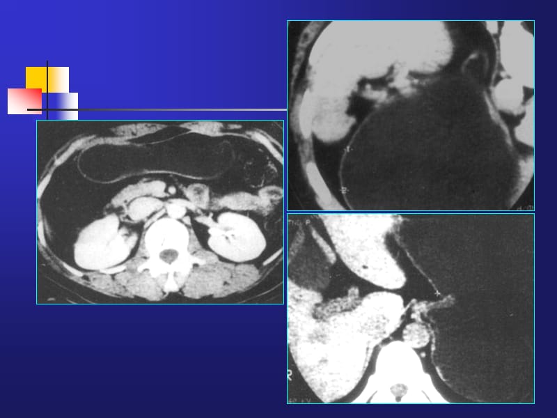 胃肿瘤CT诊断_新疆石河子大学.ppt_第3页