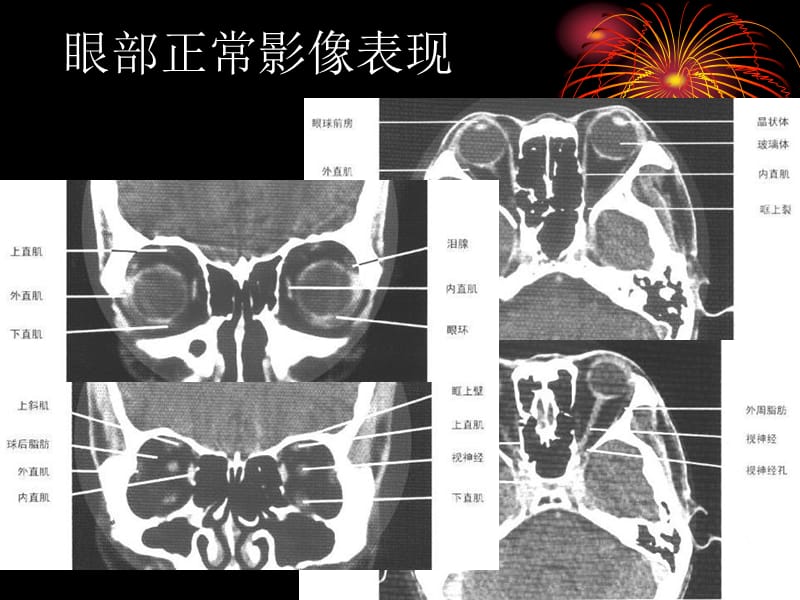 头颈部疾病CT诊断PPT课件.ppt_第3页