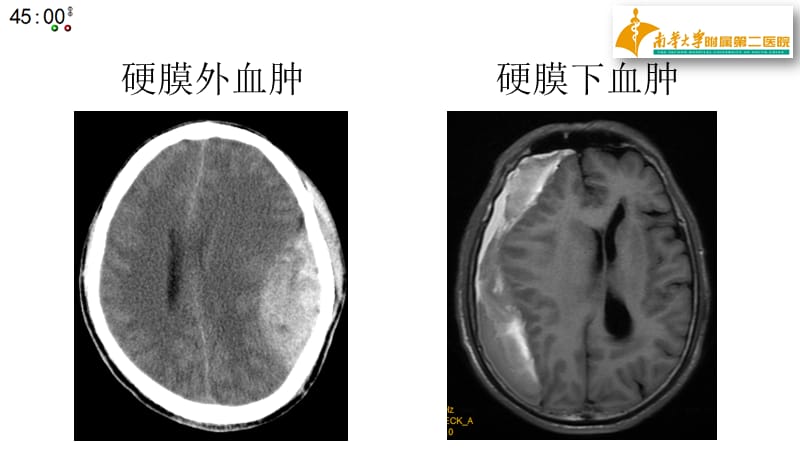 2019年基层神经外科常见引流管介绍.ppt_第3页