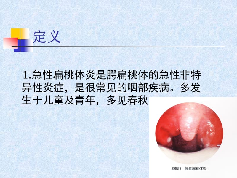 急性扁桃腺炎PPT课件.ppt_第2页