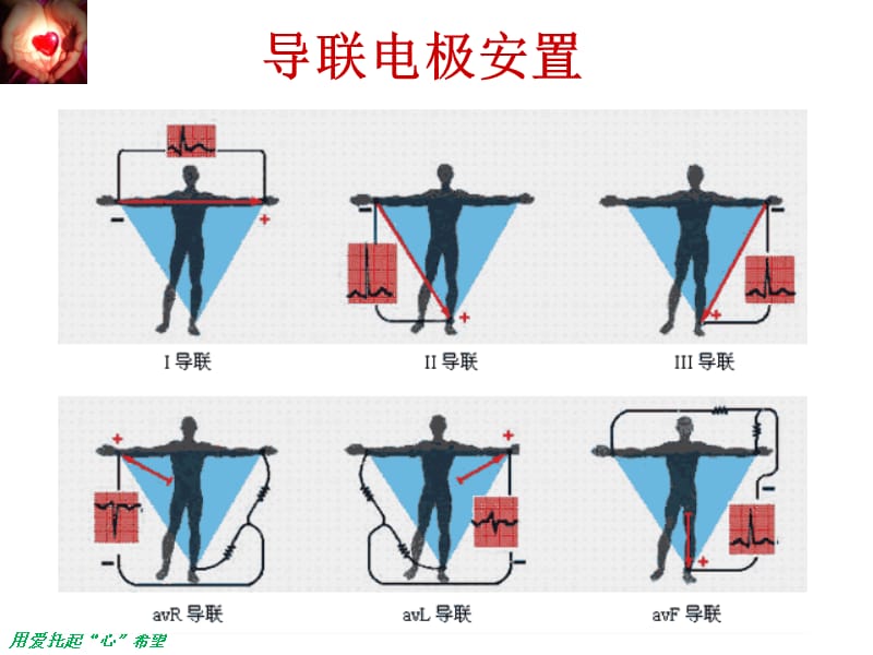 常见心律失常的识别PPT课件.ppt_第3页