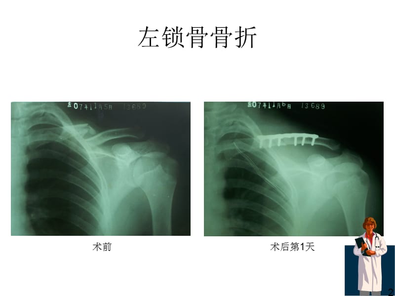 《骨折x线片汇总》ppt课件(2).ppt_第2页