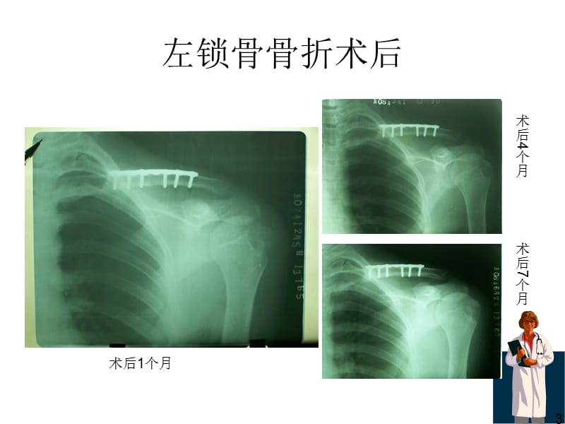 《骨折x线片汇总》ppt课件(2).ppt_第3页