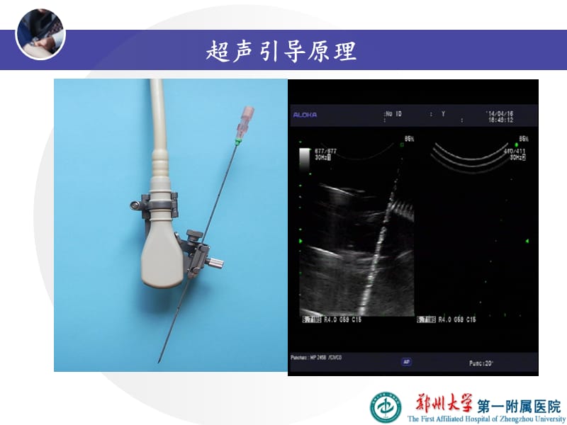 超声引导下甲状腺结节细针穿刺技术ppt课件.ppt_第2页