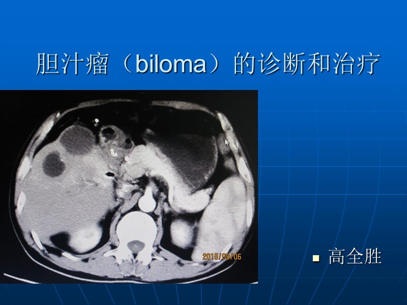 胆汁瘤biloma的诊断和治疗ppt课件.ppt_第1页