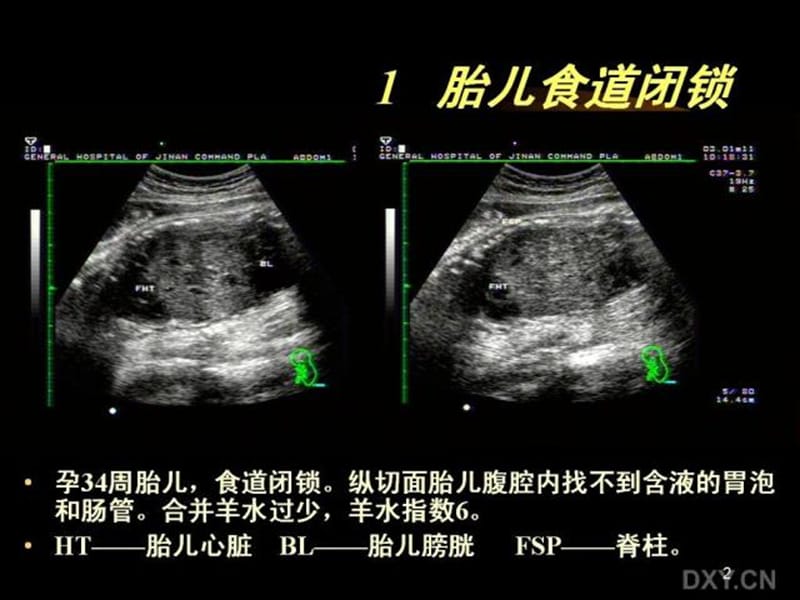 胎儿腹部畸形的超声诊断PPT课件.ppt_第2页