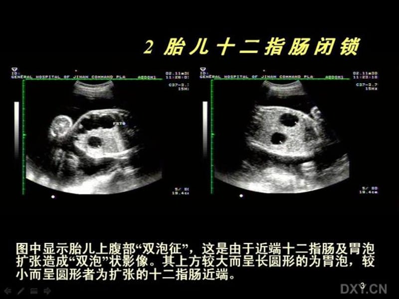 胎儿腹部畸形的超声诊断PPT课件.ppt_第3页