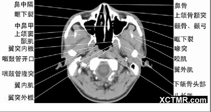 2019年《头颈五官CT》PPT课件.ppt_第3页