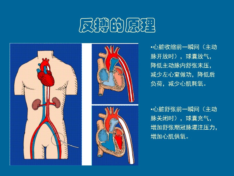 2019年iabpautocat概述经整理ppt课件.ppt_第3页